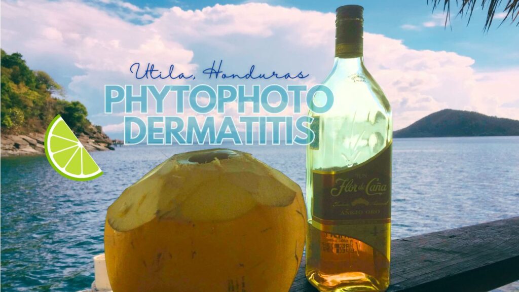 Rum Coconut Coco Loco Phytophotodermatitis